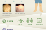 수두.png